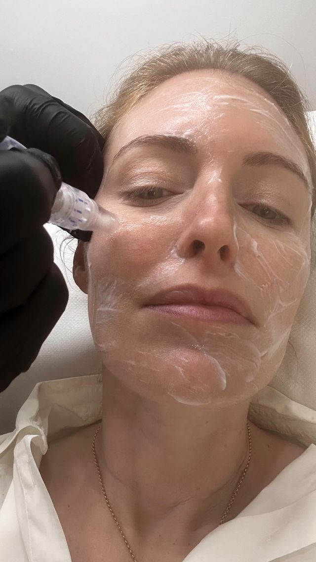 On Friday I visited the lovely Dr Ahmed El Muntasar AKA @theaestheticsdoctor to try @skinpen_uk microneedling Precision device , £300 per session, a microneedling treatment that works to treat pigmentation, enlarged pores, acne scars, fine lines and wrinkles. It’s good at thickening up fine, crepey skin.

Used on the body it’s also very helpful for reducing the appearance of stretch marks (even old, silvery ones) and surgical scars such as C-section scars with minimal downtime. It can also be done on wrinkly areas such as the tops of knees or underarms and around the belly button area.

The treatment creates temporary microscopic channels in your skin which activates your body’s natural skin-healing power to increase collagen and elastin, so your skin returns to a bouncier, brighter looking and youthful appearance. Indeed when I rocked up to the BABTEC awards last night my dinner date Teresa Tarmey asked me what I’d been doing and told me how fresh I looked – so I’ll take this as a massive skin win and will definately be repeating this treatment which is FDA-cleared and backed with clinical data to support the efficacy of its results.

I couldn’t recommend Dr Ahmed more if you are nervous around needles – he is super empathetic and kind and so much fun..Do you include microneedling in your beauty routine?  Please tell me what works for you. 

#theeditorslist #editorslist #skinpen #microneedling